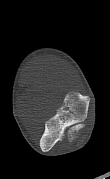 File:Chronic osteomyelitis of the distal humerus (Radiopaedia 78351-90971 Axial bone window 88).jpg