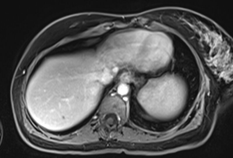 File:Chronic pancreatitis - pancreatic duct calculi (Radiopaedia 71818-82250 Axial T1 C+ fat sat 6).jpg