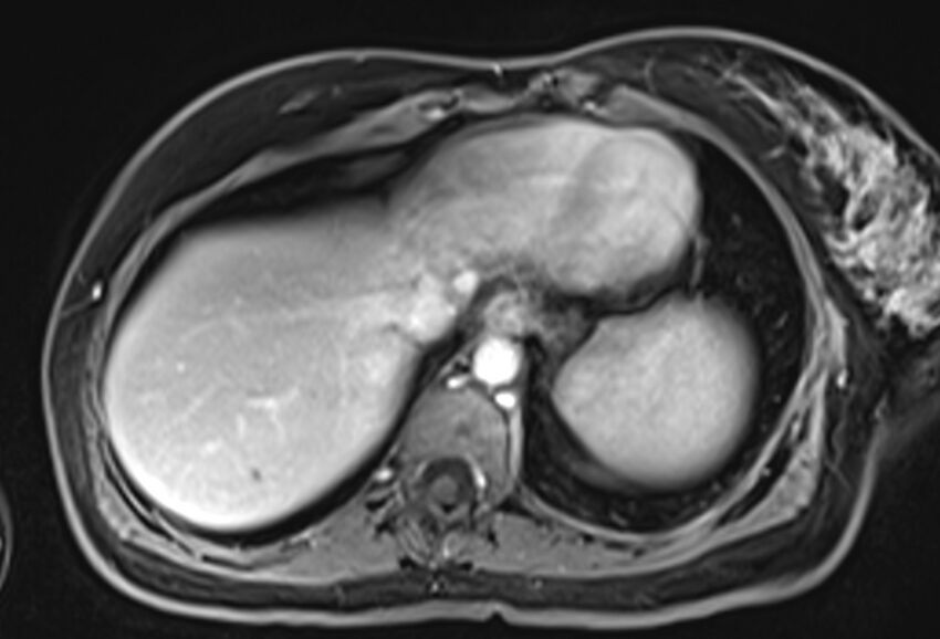 Chronic pancreatitis - pancreatic duct calculi (Radiopaedia 71818-82250 Axial T1 C+ fat sat 6).jpg