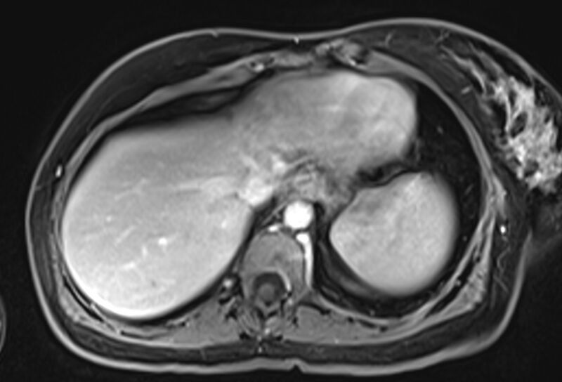 File:Chronic pancreatitis - pancreatic duct calculi (Radiopaedia 71818-82250 Axial T1 C+ fat sat 7).jpg