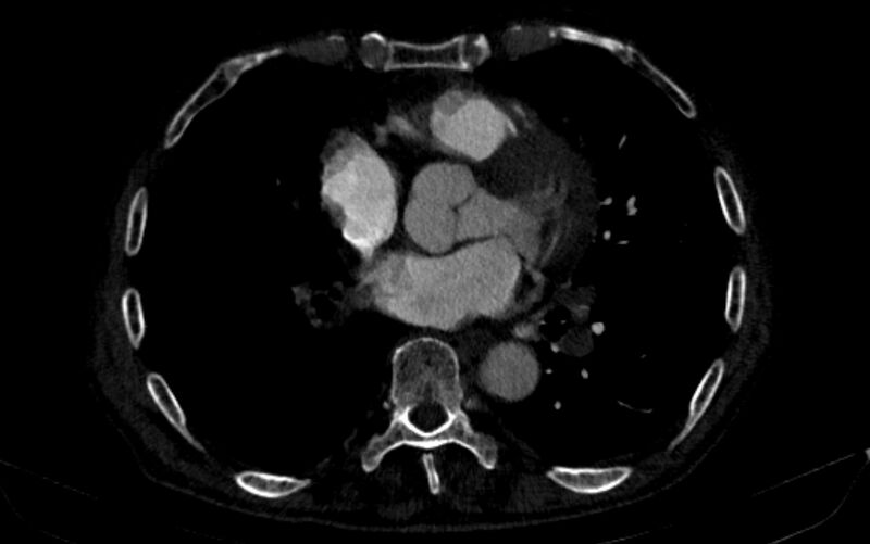 File:Chronic pulmonary embolism (Radiopaedia 91241-108843 B 116).jpg