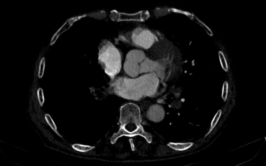 Chronic pulmonary embolism (Radiopaedia 91241-108843 B 116).jpg