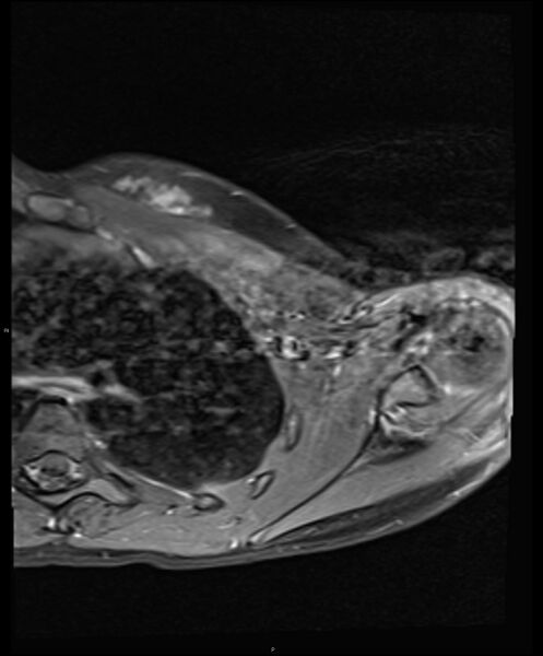 File:Chronic reactive multifocal osteomyelitis (CRMO) - clavicle (Radiopaedia 56406-63114 Axial T1 C+ fat sat 14).jpg