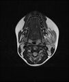 Chronic reactive multifocal osteomyelitis (CRMO) - mandible (Radiopaedia 56405-63069 Axial T2 10).jpg
