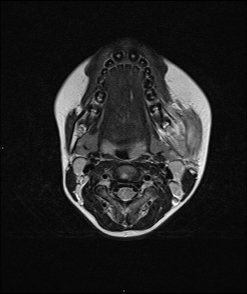 File:Chronic reactive multifocal osteomyelitis (CRMO) - mandible (Radiopaedia 56405-63069 Axial T2 10).jpg
