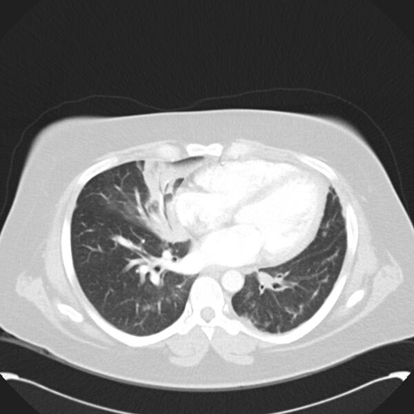 File:Chronic thromboembolic pulmonary hypertension (CTEPH) (Radiopaedia 74597-85531 Axial lung window 31).jpg