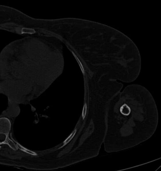 File:Clear cell chondrosarcoma - humerus (Radiopaedia 63104-71612 Axial bone window 100).jpg