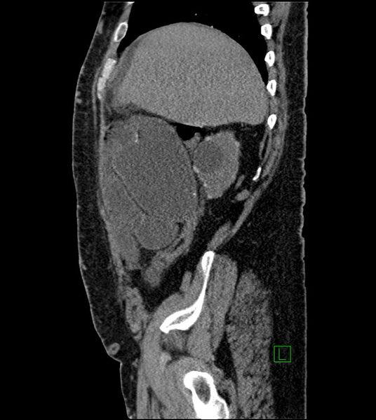 File:Closed-loop small bowel obstruction-internal hernia (Radiopaedia 78439-91096 C 112).jpg