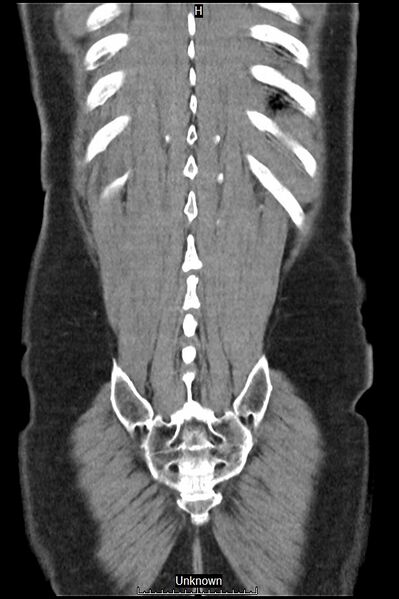 File:Closed loop bowel obstruction and ischemia (Radiopaedia 86959-103180 B 43).jpg