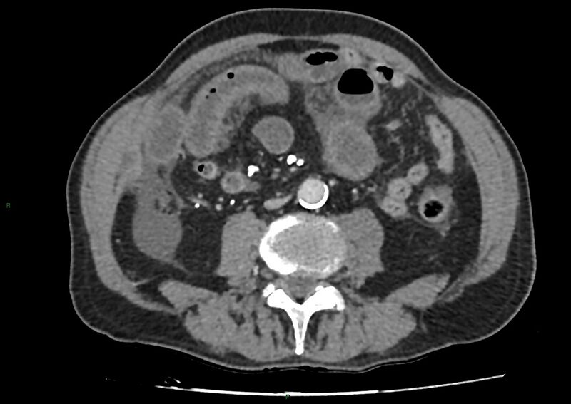 File:Closed loop small bowel obstruction with ischemia (Radiopaedia 84180-99456 A 65).jpg
