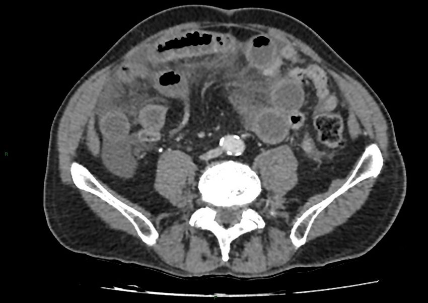 Closed loop small bowel obstruction with ischemia (Radiopaedia 84180-99456 A 74).jpg