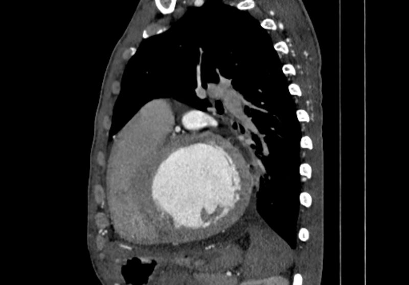 File:Coarctation of aorta with aortic valve stenosis (Radiopaedia 70463-80574 B 124).jpg