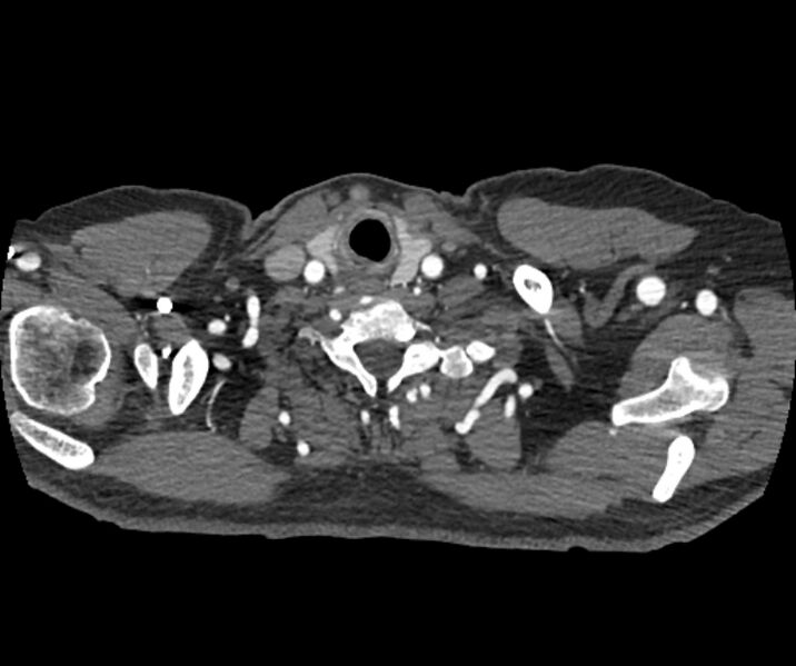 File:Coarctation of the aorta (Radiopaedia 53752-59822 A 11).jpg
