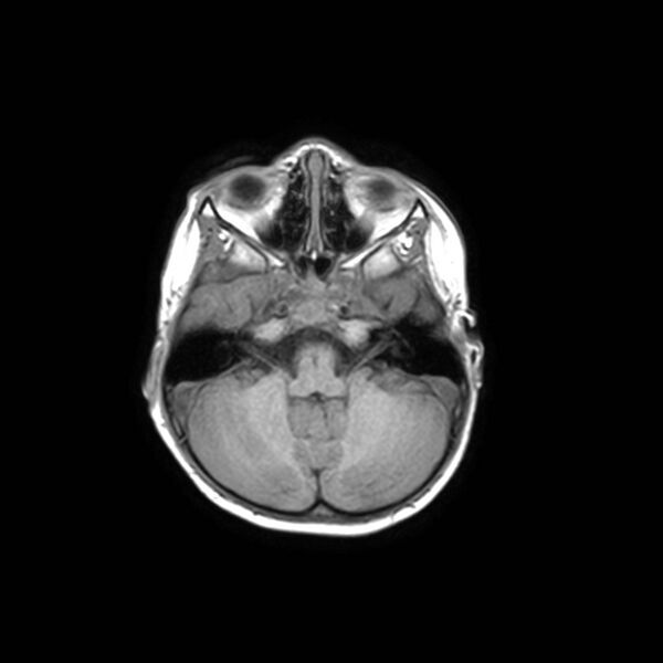 File:Cochlear nerve aplasia - unilateral (Radiopaedia 87910-104413 Axial T1 10).jpg