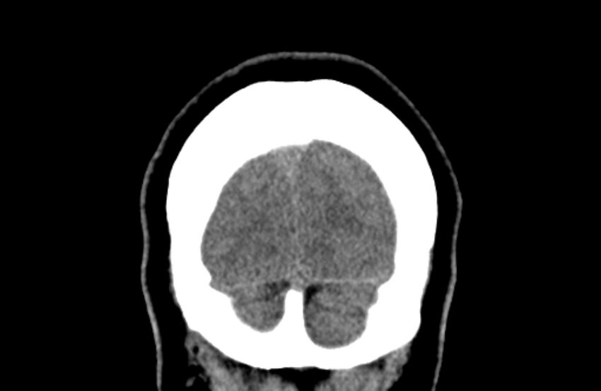 Colloid cyst (Radiopaedia 53180-59146 Coronal non-contrast 80).jpg