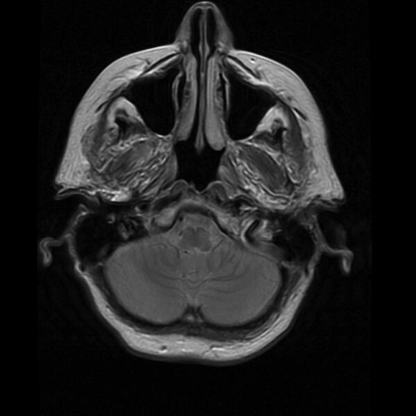 File:Colloid cyst with hydrocephalus (Radiopaedia 9373-10065 Axial PD 3).jpg