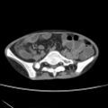 Colocolic fistula - Crohn disease (Radiopaedia 57063-63955 A 57).jpg