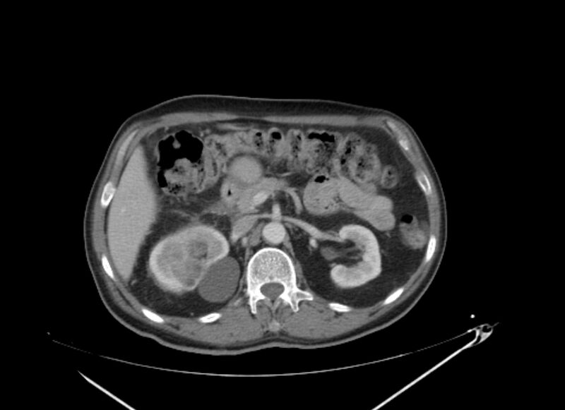 File:Colon cancer mimicking renal cell carcinoma (Radiopaedia 28986-29335 C 26).jpg