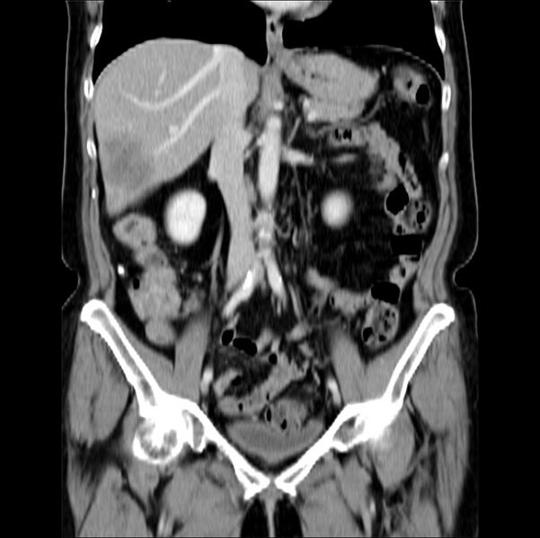 File:Colon carcinoma with hepatic metastases (Radiopaedia 29477-29961 B 22).jpg