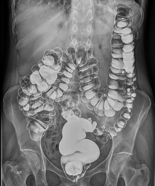 File:Colonic diverticulosis (Radiopaedia 59378-66739 Frontal 1).PNG