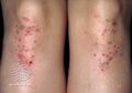 Dermatitis herpetiformis (DermNet NZ immune-s-dh5).jpg