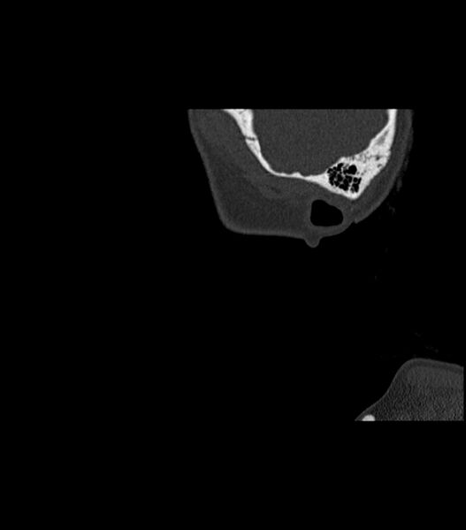 File:Nasoorbitoethmoid fracture (Radiopaedia 90044-107205 Sagittal bone window 12).jpg
