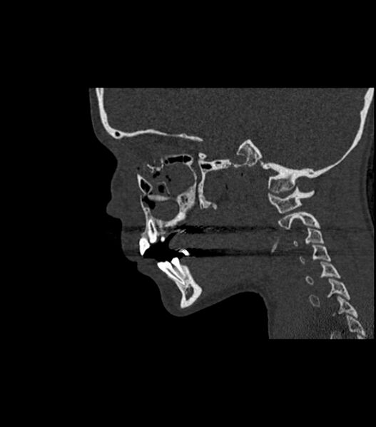 File:Nasoorbitoethmoid fracture (Radiopaedia 90044-107205 Sagittal bone window 89).jpg