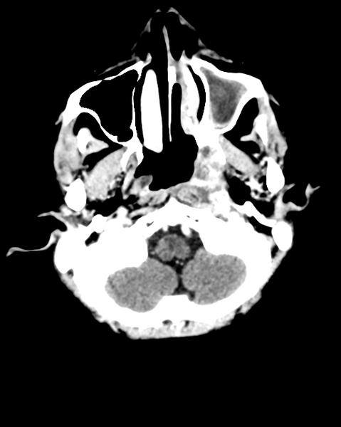 File:Nasopharyngeal carcinoma with cerebral abscess (Radiopaedia 43018-46275 Axial C+ delayed 8).png