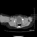 Neonatal neuroblastoma (Radiopaedia 56651-63438 Axial non-contrast 75).jpg
