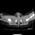 Neonatal neuroblastoma (Radiopaedia 56651-63438 Axial non-contrast 85).jpg