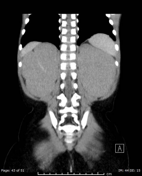 File:Nephroblastomatosis (Radiopaedia 41934-44935 B 43).jpg