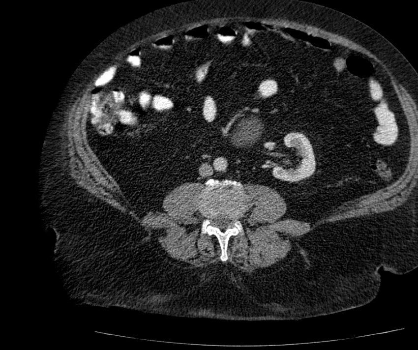 Nephroptosis with inguinal hernia containing perirenal fat (Radiopaedia 56632-63391 C 200).jpg