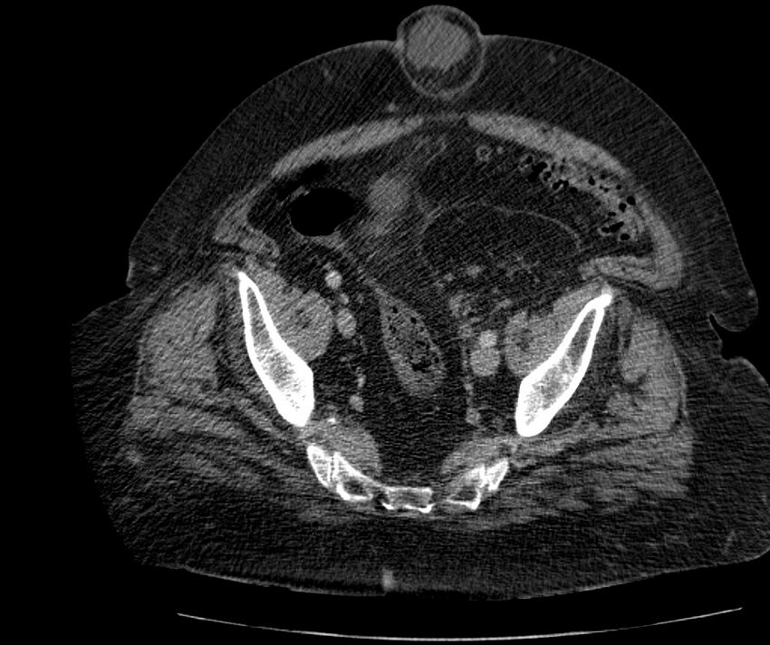 Nephroptosis with inguinal hernia containing perirenal fat (Radiopaedia 56632-63391 C 283).jpg