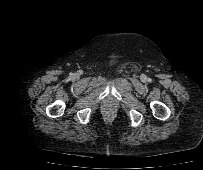 Nephroptosis with inguinal hernia containing perirenal fat (Radiopaedia 56632-63391 C 341).jpg