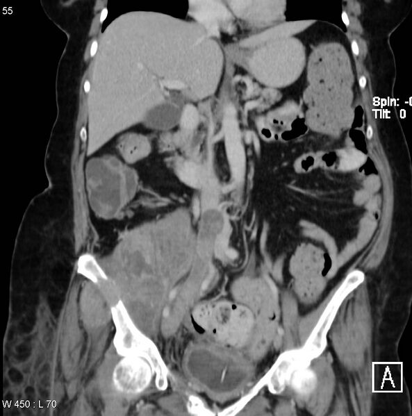 File:Nerve sheath tumor - malignant - sacrum (Radiopaedia 5219-6987 B 4).jpg