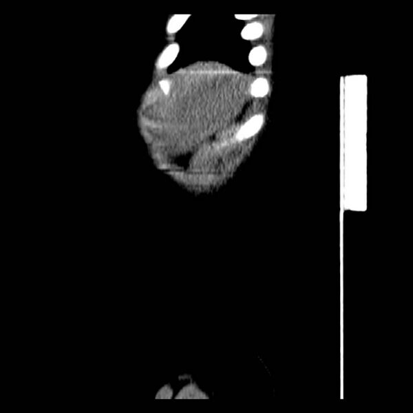 File:Neuroblastoma with skull metastases (Radiopaedia 30326-30960 B 46).jpg