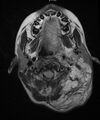 Neurofibromatosis type 1 (Radiopaedia 6954-8063 Axial T2 1).jpg