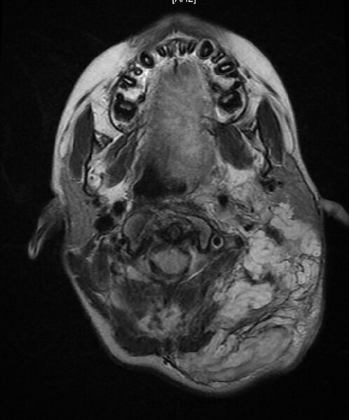 File:Neurofibromatosis type 1 (Radiopaedia 6954-8063 Axial T2 1).jpg