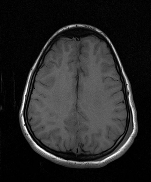 File:Neurofibromatosis type 2 (Radiopaedia 66211-75401 Axial T1 20).jpg