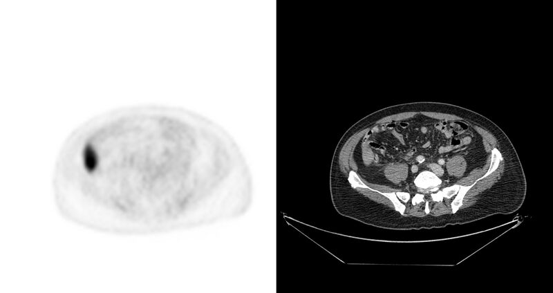 File:Non-Hodgkin lymphoma involving seminal vesicles with development of interstitial pneumonitis during Rituximab therapy (Radiopaedia 32703-33675 axial PET CT 18).jpg