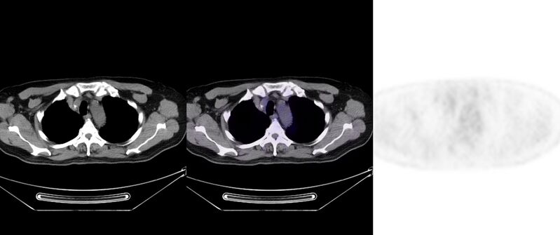 File:Non-Hodgkin lymphoma involving seminal vesicles with development of interstitial pneumonitis during Rituximab therapy (Radiopaedia 32703-33752 ax CT Fus PET 15).jpg