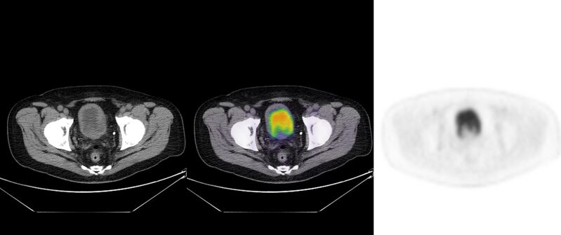 File:Non-Hodgkin lymphoma involving seminal vesicles with development of interstitial pneumonitis during Rituximab therapy (Radiopaedia 32703-33752 ax CT Fus PET 59).jpg
