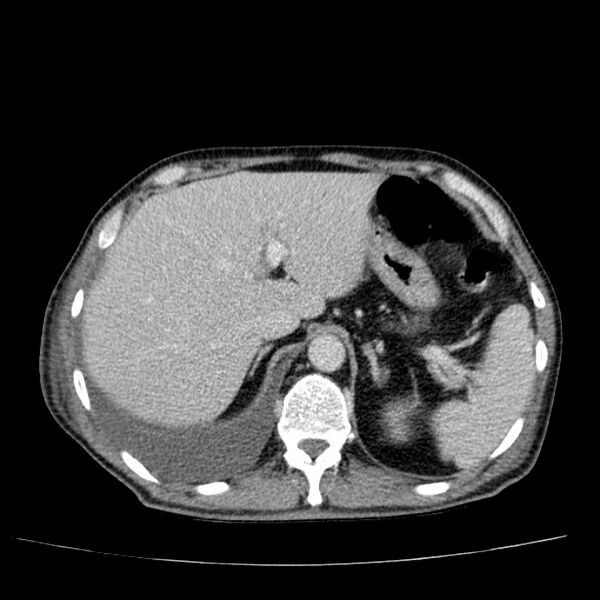 File:Non small-cell lung cancer (Radiopaedia 24467-24769 C+ delayed 58).jpg