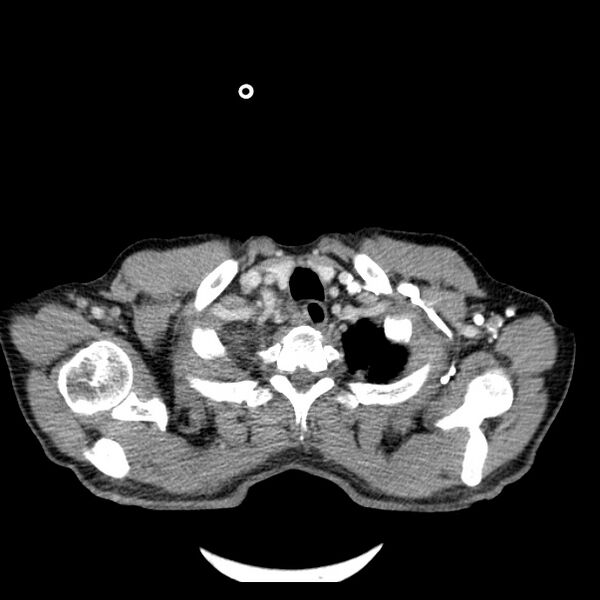 File:Non small-cell lung cancer (Radiopaedia 24467-24769 C+ delayed 8).jpg