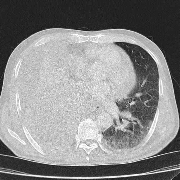 File:Non small-cell lung cancer (Radiopaedia 24467-24769 lung window 29).jpg