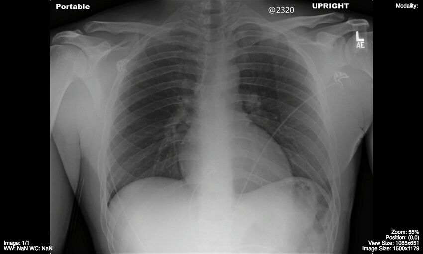 Normal AP (portable) chest x-ray.jpg
