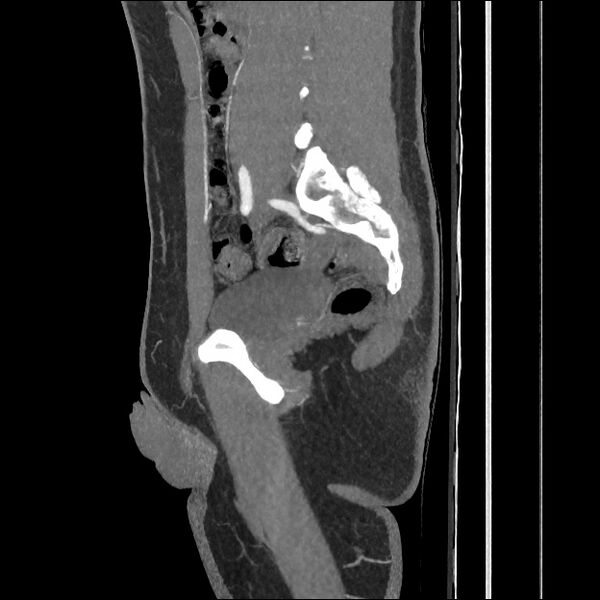 File:Normal CT angiogram of pelvis (Radiopaedia 45390-49430 C 43).jpg