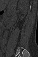 Normal CT lumbar spine (Radiopaedia 53981-60118 Sagittal bone window 86).jpg