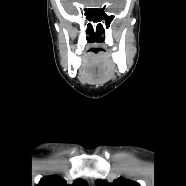 File:Normal CT of the neck (Radiopaedia 14575-14500 Coronal C+ 18).jpg