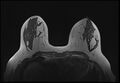 Normal breast MRI - dense breasts (Radiopaedia 80454-93850 Axial T1 99).jpg